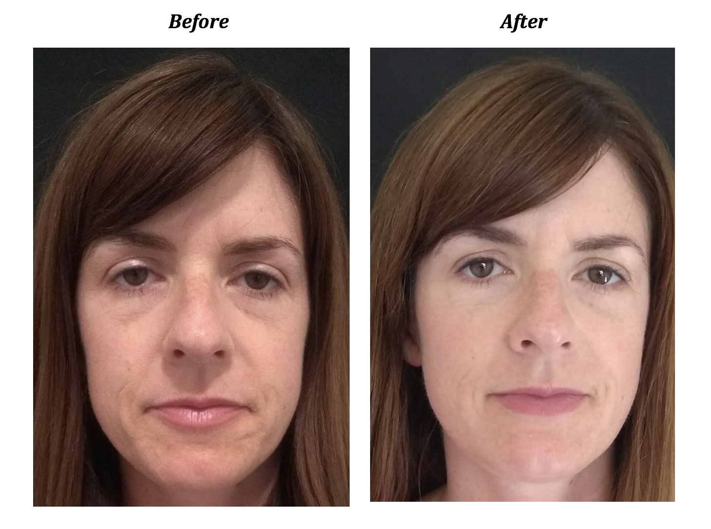 Cosmetic Acupuncture Archives Healing InSightHealing InSight