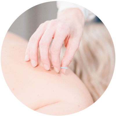 acupuncture-treatment